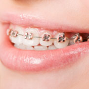 orthodontic treatments